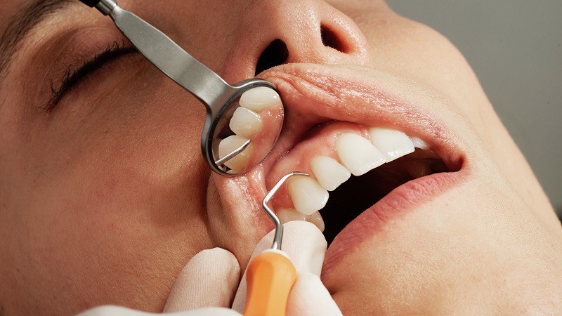 مزیت ها و معایب انجام کورتاژ لثه | بهترین دندانپزشک اصفهان | دکتر ندا مکانیک