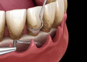 بهترین ایمپلنت اصفهان | بهترین دندانپزشک اصفهان | معرفی انواع مختلف کورتاژ لثه | بهترین دندانپزشک اصفهان | دکتر ندا مکانیک