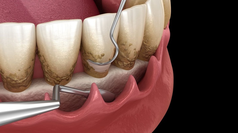 معرفی انواع مختلف کورتاژ لثه | بهترین دندانپزشک اصفهان | دکتر ندا مکانیک