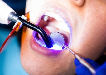 بهترین ایمپلنت اصفهان | بهترین دندانپزشک زیبایی اصفهان | بهترین دندانپزشک اصفهان | دکتر ندا مکانیک | موارد استفاده از کامپوزیت دندان