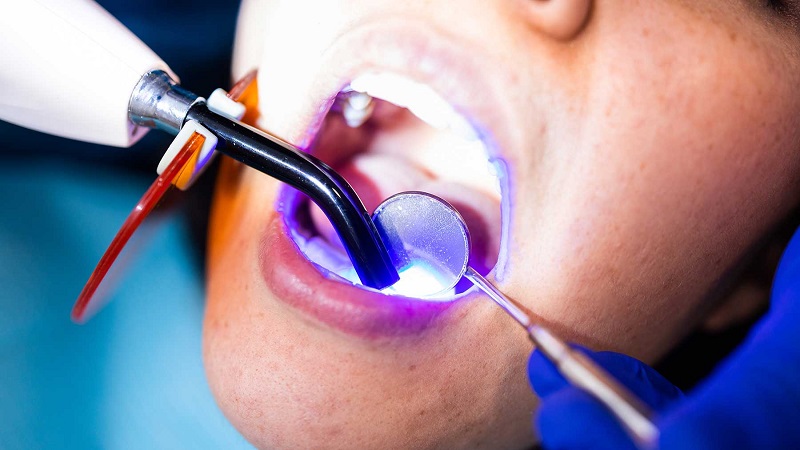 بهترین ایمپلنت اصفهان | بهترین دندانپزشک زیبایی اصفهان | بهترین دندانپزشک اصفهان | دکتر ندا مکانیک | موارد استفاده از کامپوزیت دندان