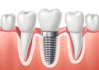 بهترین ایمپلنت اصفهان | بهترین دندانپزشک زیبایی اصفهان | دکتر ندا مکانیک | موارد نیاز به تعویض ایمپلنت دندان | بهترین ایمپلنت اصفهان | دکتر ندا مکانیک