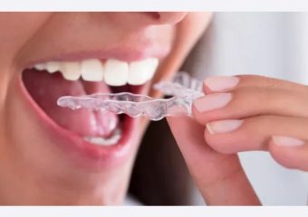 بهترین ایمپلنت اصفهان | بهترین دندانپزشک اصفهان | نکات مراقبتی از نایت گارد دهانی | بهترین دندانپزشک اصفهان | دکتر ندا مکانیک