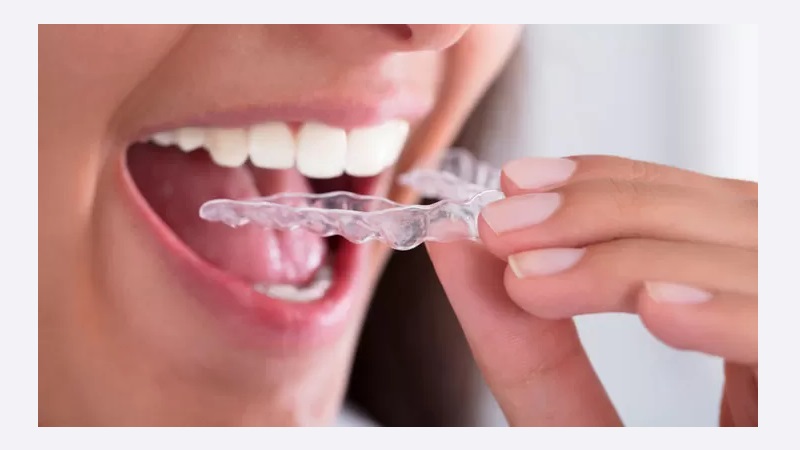 نکات مراقبتی از نایت گارد دهانی | بهترین دندانپزشک اصفهان | دکتر ندا مکانیک