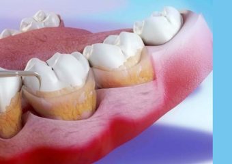 بهترین ایمپلنت اصفهان | بهترین دندانپزشک اصفهان | نکات مراقبتی لازم بعد از کورتاژ لثه | بهترین دندانپزشک اصفهان | دکتر ندا مکانیک