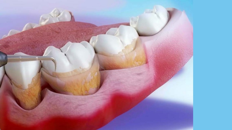 بهترین ایمپلنت اصفهان | بهترین دندانپزشک اصفهان | نکات مراقبتی لازم بعد از کورتاژ لثه | بهترین دندانپزشک اصفهان | دکتر ندا مکانیک
