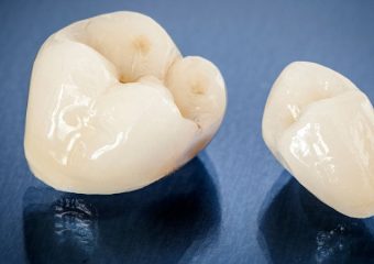 پیشرفتهای تکنولوژیکی در ساخت روکشهای دندانی | بهترین ایمپلنت اصفهان | بهترین دندانپزشک اصفهان | دکتر ندا مکانیک