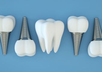 بهترین دندانپزشک اصفهان |چگونگی و علل تعویض ایمپلنت دندان | بهترین ایمپلنت اصفهان | دکتر ندا مکانیک