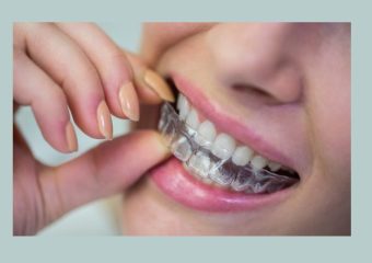 بهترین ایمپلنت اصفهان | بهترین دندانپزشک اصفهان | کاربرد انواع مختلف محافظ دهان | بهترین دندانپزشک اصفهان | دکتر ندا مکانیک