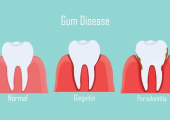 بروز تحلیل لثه پس از انجام لمینت دندان | بهترین دندانپزشک زیبایی اصفهان | دکتر ندا مکانیک