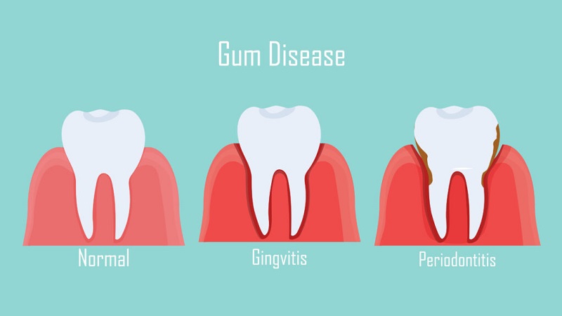 بروز تحلیل لثه پس از انجام لمینت دندان | بهترین دندانپزشک زیبایی اصفهان | دکتر ندا مکانیک