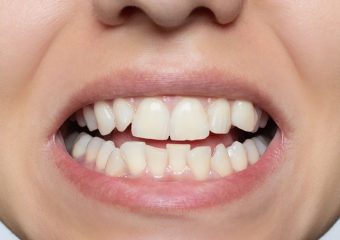 بهترین ایمپلنت اصفهان | بهترین دندانپزشک اصفهان | تأثیر زبان زدن به لثه بر کجی دندان‌ها | بهترین دندانپزشک کودکان اصفهان | دکتر ندا مکانیک