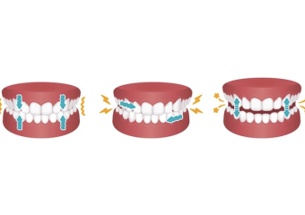 تأثیر کاشت ایمپلنت بر بروز دندان قروچه | بهترین ایمپلنت اصفهان | دکتر ندا مکانیک