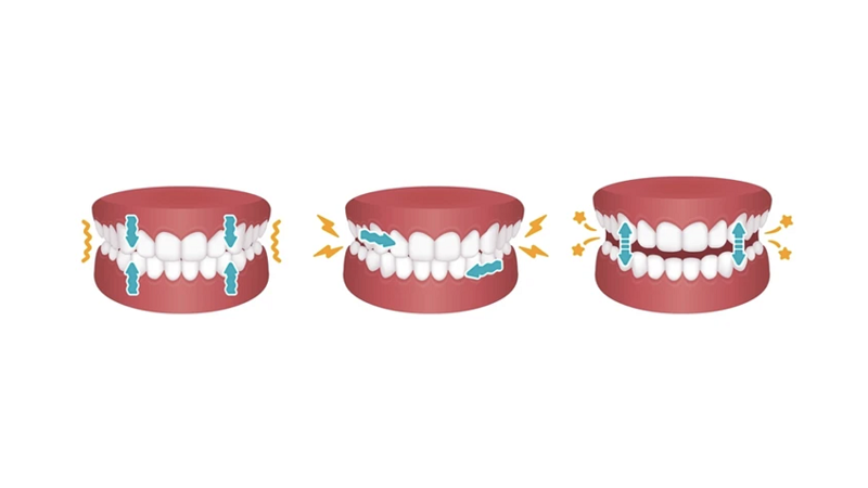 تأثیر کاشت ایمپلنت بر بروز دندان قروچه | بهترین ایمپلنت اصفهان | دکتر ندا مکانیک