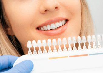 بهترین ایمپلنت اصفهان | ترک‌های میکروسکوپی لمینت دندان | بهترین دندانپزشک زیبایی اصفهان | دکتر ندا مکانیک