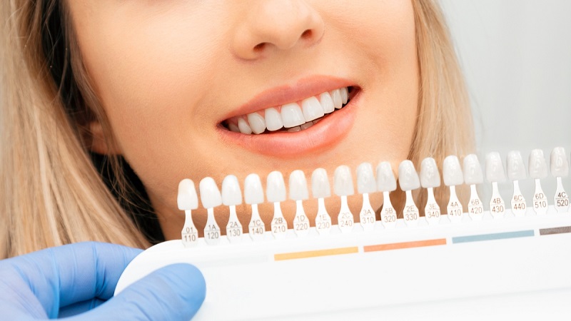 بهترین ایمپلنت اصفهان | ترک‌های میکروسکوپی لمینت دندان | بهترین دندانپزشک زیبایی اصفهان | دکتر ندا مکانیک