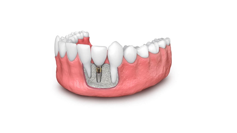 جایگزین های پیوند استخوان در موارد تحلیل شدید استخوان در ایمپلنت دندان | بهترین ایمپلنت اصفهان | دکتر ندا مکانیک