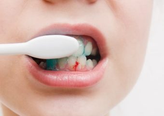 بهترین ایمپلنت اصفهان | بهترین دندانپزشک اصفهان | خونریزی لثه‌ها هنگام مسواک زدن | بهترین دندانپزشک اصفهان | دکتر ندا مکانیک