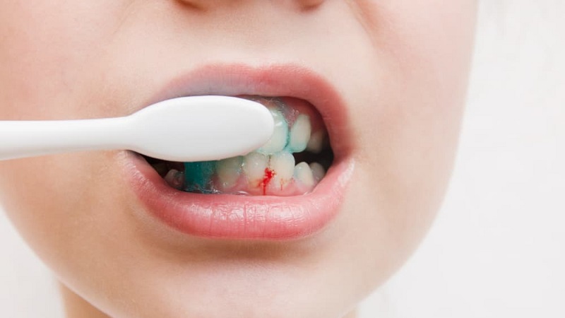 خونریزی لثه‌ها هنگام مسواک زدن | بهترین دندانپزشک اصفهان | دکتر ندا مکانیک