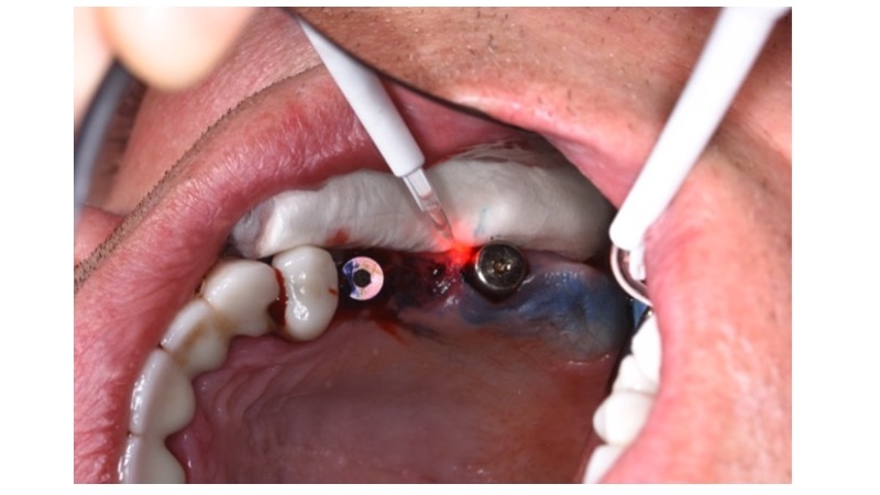 درمان پری ایمپلنت با لیزر | بهترین ایمپلنت اصفهان | دکتر ندا مکانیک