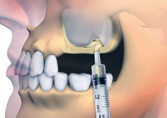 بهترین ایمپلنت اصفهان | بهترین دندانپزشک اصفهان | راه حل های مقابله با عوارض لیفت سینوس | دکتر ندا مکانیک