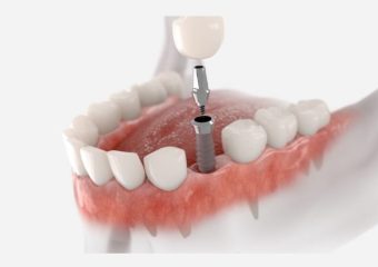 طول دوره ریکاوری فک و لثه در کاشت ایمپلنت دندان | بهترین ایمپلنت اصفهان | دکتر ندا مکانیک