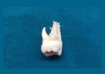 بهترین ایمپلنت اصفهان | بهترین دندانپزشک اصفهان | عارضه هایپرتروفی یا بزرگ شدن ریشه دندان | بهترین دندانپزشک اصفهان | دکتر ندا مکانیک