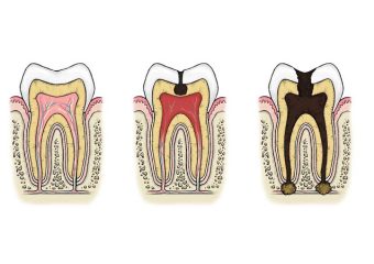 بهترین ایمپلنت اصفهان | عفونت پالپ دندان قبل و بعد از کاشت ایمپلنت | بهترین ایمپلنت اصفهان | دکتر ندا مکانیک