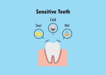 بهترین ایمپلنت اصفهان | بهترین دندانپزشک اصفهان | علل حساس شدن دندان‌ها پس از روکش کردن | بهترین دندانپزشک اصفهان | دکتر ندا مکانیک