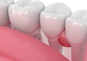 بهترین ایمپلنت اصفهان | بهترین دندانپزشک اصفهان | علل و راهکارهای پیشگیری و مدیریت کیست‌های لثه پراکنده | بهترین دندانپزشک اصفهان | دکتر ندا مکانیک