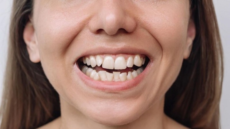 بهترین ایمپلنت اصفهان | بهترین دندانپزشک اصفهان | علل، پیشگیری و درمان های کجی دندان | بهترین دندانپزشک زیبایی اصفهان | دکتر ندا مکانیک