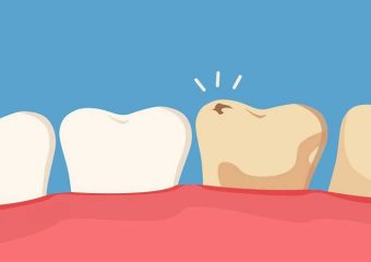 عوارض مصرف الکل بر عملکرد کامپوزیت دندان | بهترین دندانپزشک زیبایی اصفهان | دکتر ندا مکانیک