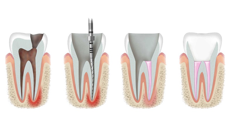 بهترین ایمپلنت اصفهان | بهترین دندانپزشک اصفهان | محدودیت‌های درمان ریشه دندان | بهترین دندانپزشک اصفهان | دکتر ندا مکانیک