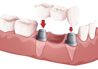 بهترین ایمپلنت اصفهان | مشکلات شایع بریج‌های دندانی در بیماران ایمپلنت‌دار | بهترین دندانپزشک اصفهان | دکتر ندا مکانیک