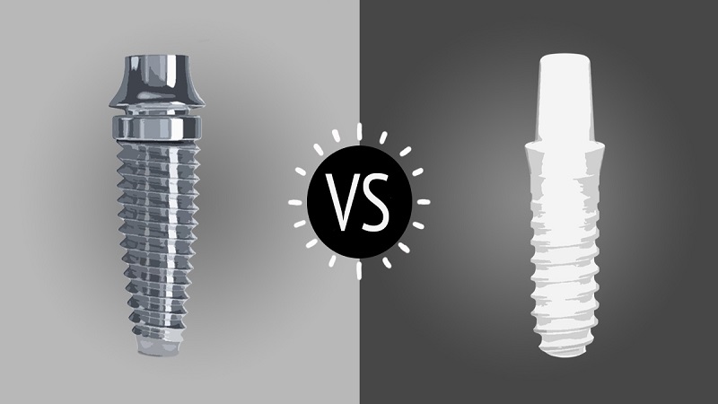 بهترین ایمپلنت اصفهان | بهترین دندانپزشک زیبایی اصفهان | دکتر ندا مکانیک | مطالعه تطبیقی ایمپلنت های زیرکونیا و تیتانیوم | بهترین ایمپلنت اصفهان | دکتر ندا مکانیک