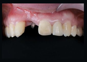 نجات ایمپلنت های ناموفق | بهترین ایمپلنت اصفهان | بهترین دندانپزشک اصفهان | دکتر ندا مکانیک