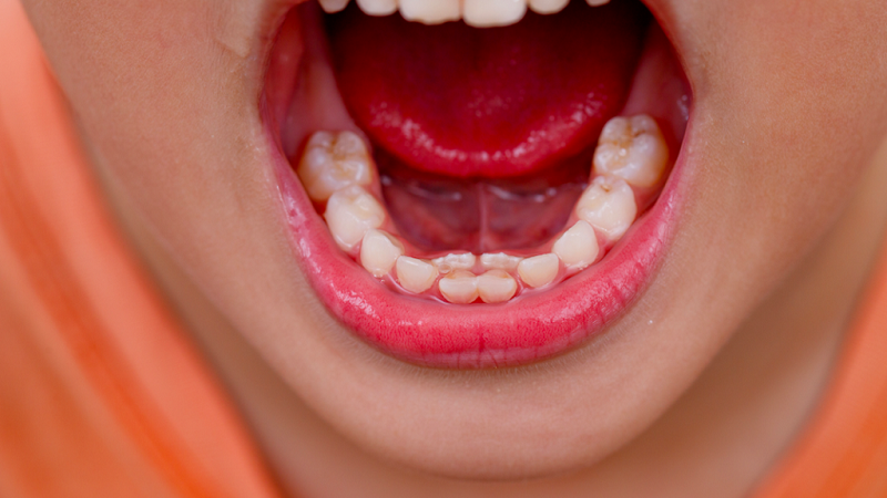 بهترین ایمپلنت اصفهان | بهترین دندانپزشک اصفهان | نیفتادن دندان شیری تا بزرگسالی | بهترین دندانپزشک اصفهان | دکتر ندا مکانیک