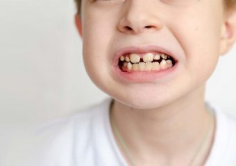 بهترین ایمپلنت اصفهان | بهترین دندانپزشک اصفهان | هیپوپلازی مینای دندان در کودکان | بهترین دندانپزشک کودکان اصفهان | دکتر ندا مکانیک