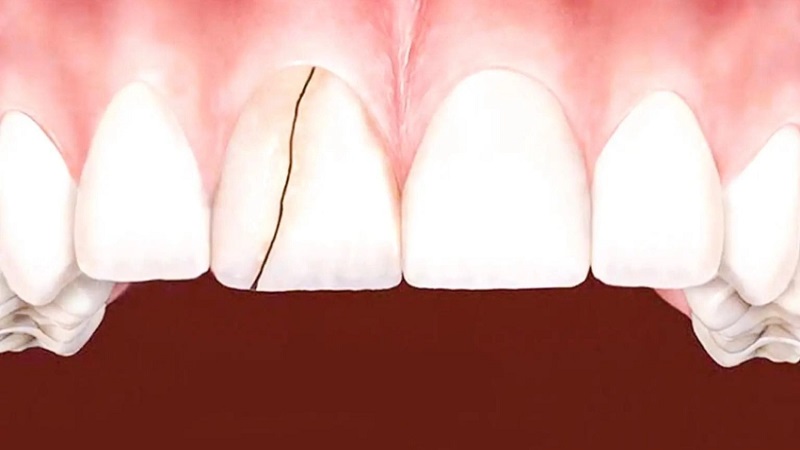 بهترین ایمپلنت اصفهان | بهترین دندانپزشک اصفهان | پیشگیری از ترک برداشتن لمینت‌های دندانی | بهترین دندانپزشک اصفهان | دکتر ندا مکانیک