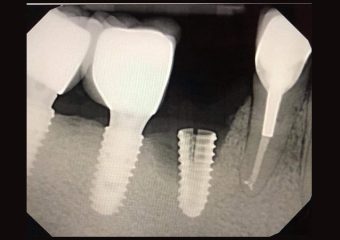 بهترین ایمپلنت اصفهان | پیشگیری از ترک‌های میکروسکوپی در ایمپلنت دندان | بهترین ایمپلنت اصفهان | دکتر ندا مکانیک