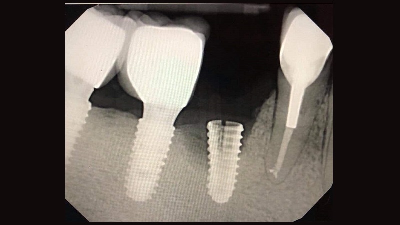 بهترین ایمپلنت اصفهان | پیشگیری از ترک‌های میکروسکوپی در ایمپلنت دندان | بهترین ایمپلنت اصفهان | دکتر ندا مکانیک