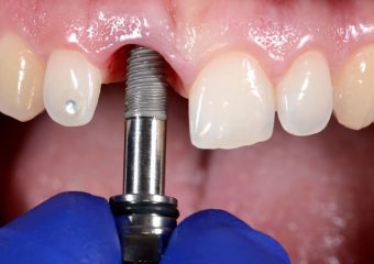 بهترین ایمپلنت اصفهان | بهترین دندانپزشک اصفهان | ایمپلنت دندان | دکتر ندا مکانیک