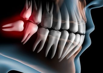 بهترین ایمپلنت اصفهان | بهترین دندانپزشک اصفهان | چالش‌های بالینی و رویکردهای مدرن برای دندان عقل شل شده | بهترین دندانپزشک اصفهان | دکتر ندا مکانیک