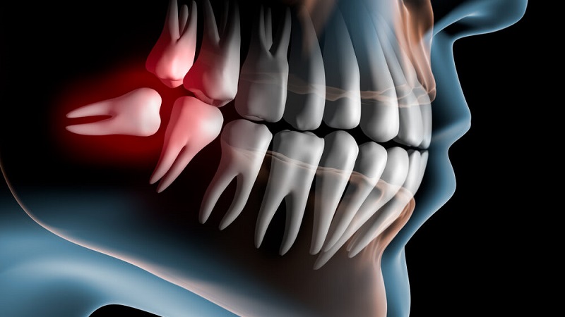 بهترین ایمپلنت اصفهان | بهترین دندانپزشک اصفهان | چالش‌های بالینی و رویکردهای مدرن برای دندان عقل شل شده | بهترین دندانپزشک اصفهان | دکتر ندا مکانیک