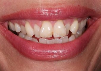 بهترین ایمپلنت اصفهان | بهترین دندانپزشک اصفهان | کامپوزیت کردن دندان‌های کج | بهترین دندانپزشک زیبایی اصفهان | دکتر ندا مکانیک