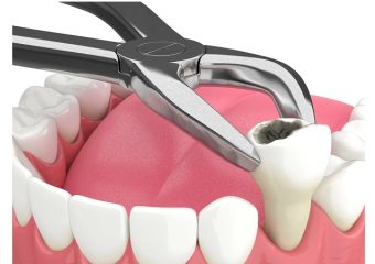 کشیدن دندان‌های مجاور در دوره کاشت ایمپلنت | بهترین ایمپلنت اصفهان | دکتر ندا مکانیک