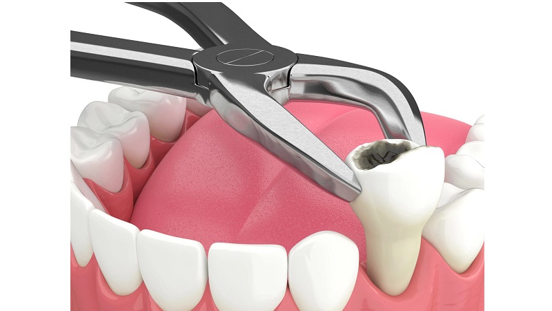کشیدن دندان‌های مجاور در دوره کاشت ایمپلنت | بهترین ایمپلنت اصفهان | دکتر ندا مکانیک