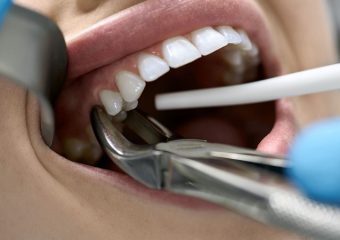 بهترین ایمپلنت اصفهان | بهترین دندانپزشک اصفهان | کنترل خونریزی پس از کشیدن دندان | بهترین دندانپزشک اصفهان | دکتر ندا مکانیک