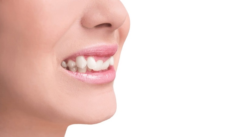 جابجا شدن دندان‌ها در بزرگسالان | بهترین ایمپلنت اصفهان | بهترین دندانپزشک اصفهان |دکتر ندا مکانیک