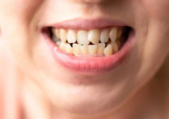 بهترین ایمپلنت اصفهان | کامپوزیت کردن دندان‌های کج | بهترین دندانپزشک اصفهان | دکتر ندا مکانیک